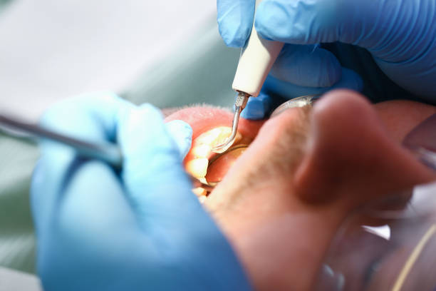 Best Chipped Tooth Repair Near Me  in Yorkvle, IL